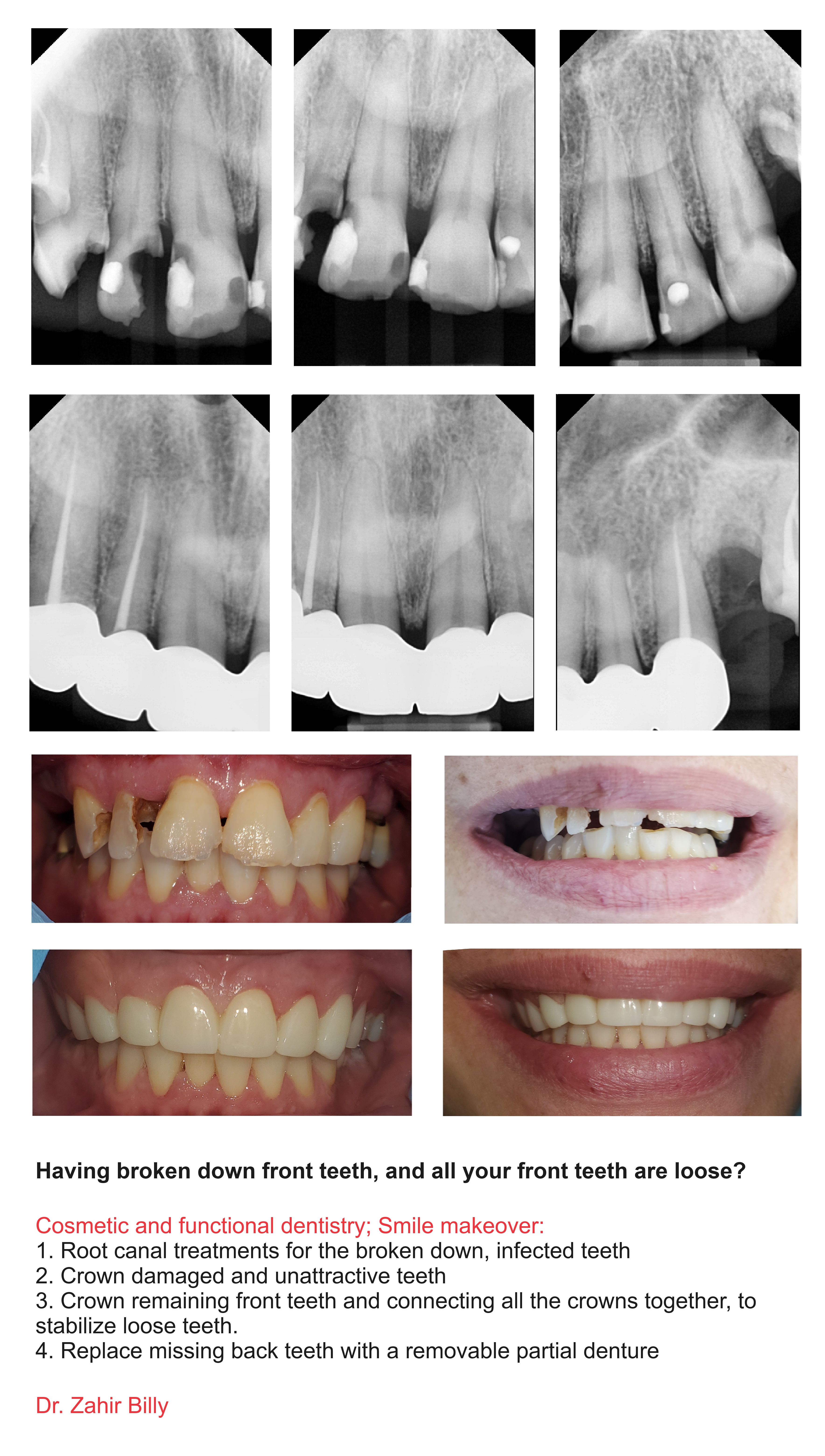 1. Root canal treatments for the broken down and infected teeth
2. Crown damaged and unattractive teeth, and connecting these crowns to stabilize the loose fron